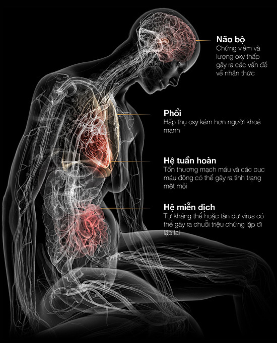 Covid-19 kéo dài tàn phá cơ thể thế nào